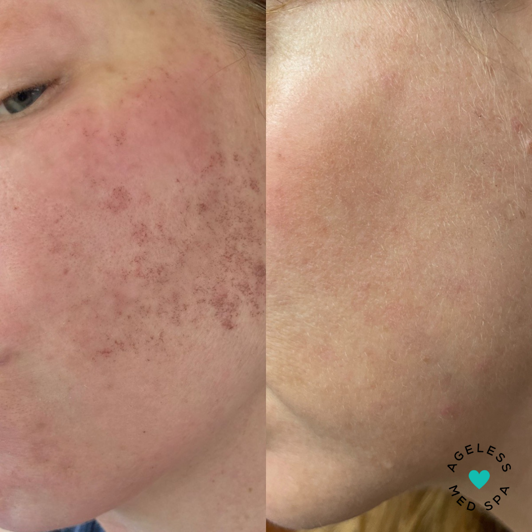 IPL 24 hrs & 1 weeks post